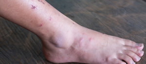 כף רגל סוכרתית: מיצוי זכויות משפטיות - תמונת אווירה